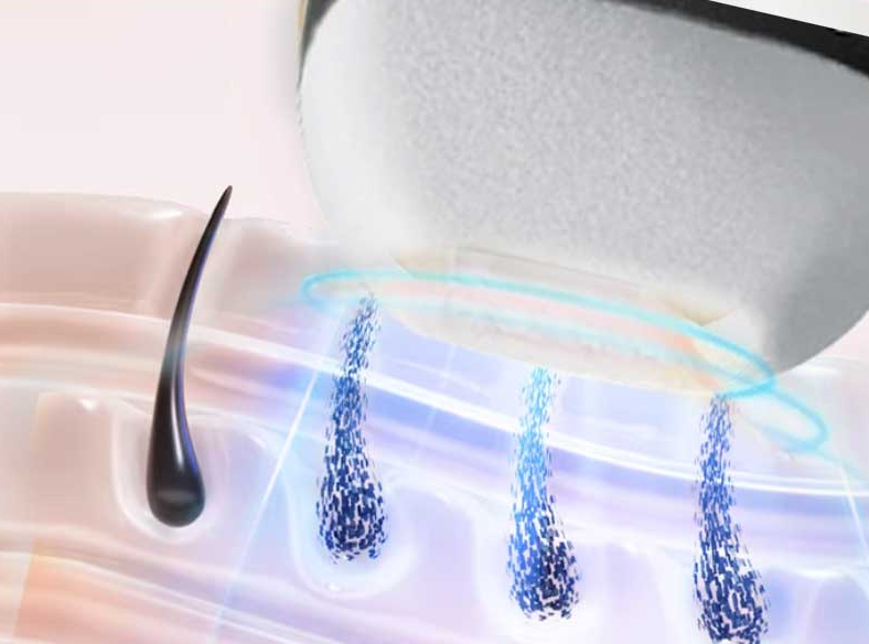 What Laser Shot Lifespan to Look for When Buying Salon Hair Removal Equipment