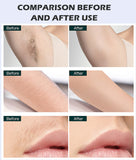 This 2-in-1 multi-functional picosecond laser hair removal device comes with an ice pack handle and can quickly remove hair. It is suitable for limbs, lips, underarms, and bikini line.