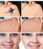 This 2-in-1 multi-functional picosecond laser hair removal device comes with an ice pack handle and can quickly remove hair. It is suitable for limbs, lips, underarms, and bikini line.