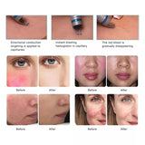 5-in-1 laser beauty device, for treating red blood vessels, eliminating nail fungus, skin regeneration, physical therapy, and herpes-related eczema