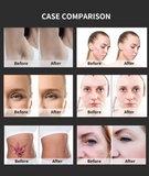OPT 2-in-1 Pico Laser Beauty Device, Facial & Body Device Hair Removal + Acne Redness Reduction