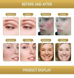 Skin-removing and whitening beauty device: removes acne, acne scars, and blackheads; rejuvenates and revitalizes skin; reduces skin sagging.