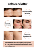 Professional Microneedling Radiofrequency Beauty Machine with Soothing Ice Hammer for Firmer Skin