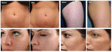 Square Gold RF Microneedling | Cooling for Sensitive Skin