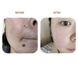 Multifunctional acne-removing and skin-whitening beauty device: removes freckles, age spots, moles, pigmentation, and brightens skin.