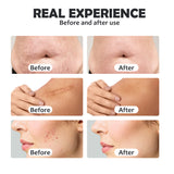 Vertical Multi-functional Microneedling RF Machine, Professionally and Effectively Tightens Skin