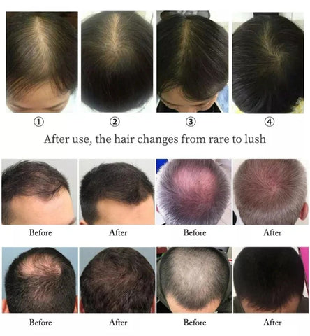 Regrow Fuller Hair with Clinical-Grade Laser Technology Hair Growth for Thinning Hair & Receding Hairline in Men & Women