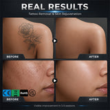 2-in-1 Diode + Pico Laser | 5000W Hair Removal & Skin Rejuv
