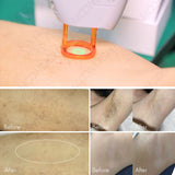 Alexandrite Laser | Hair Removal, Acne & Vascular Treatment