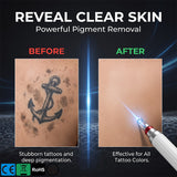 Portable Picosecond Laser – Tattoo Removal & Skin Renewal