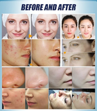 Professional Multifunctional Facial Cleansing Instrument to Remove Black Oil and Grease