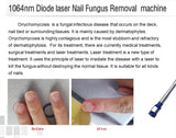 980nm vertical screen, professional onychomycosis removal, portable beauty device