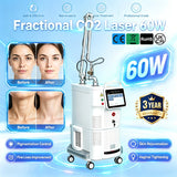 Vaginal Tightening CO2 Laser Machine – Ergonomic 5-in-1 Skin & Intimate Care System