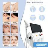 4-in-1 Multi-functional Laser Beauty Tool: Comfortable Hair Removal, Skin Whitening and Rejuvenation