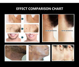 Black Knight New in Diode Laser Hair Removal Machin 755/808/940/1064nm 4 Wavelengths Cooling Head Painless Laser Epilator Body Hair Removal