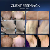 Black Soprano 808 Beginner-Friendly Hair Removal Device, Permanent Hair Removal Device, Suitable for Sensitive Skin, Dedicated for Face, Limbs, and Body Hair Removal